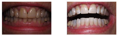 Zoom Whitening Systems